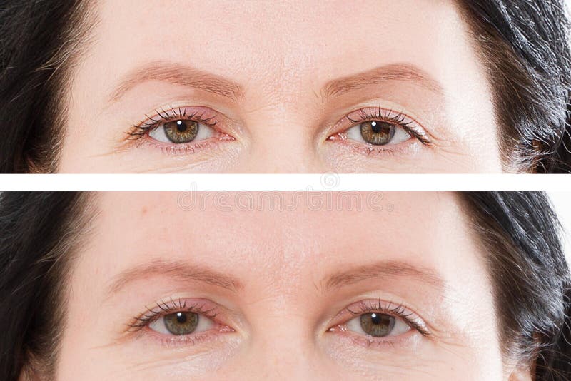 Before after eyebrow threading and eyebrows shaping cosmetic procedure. Closeup middle age woman face. Before-after skin and. Forehead. Anti aging concept stock image